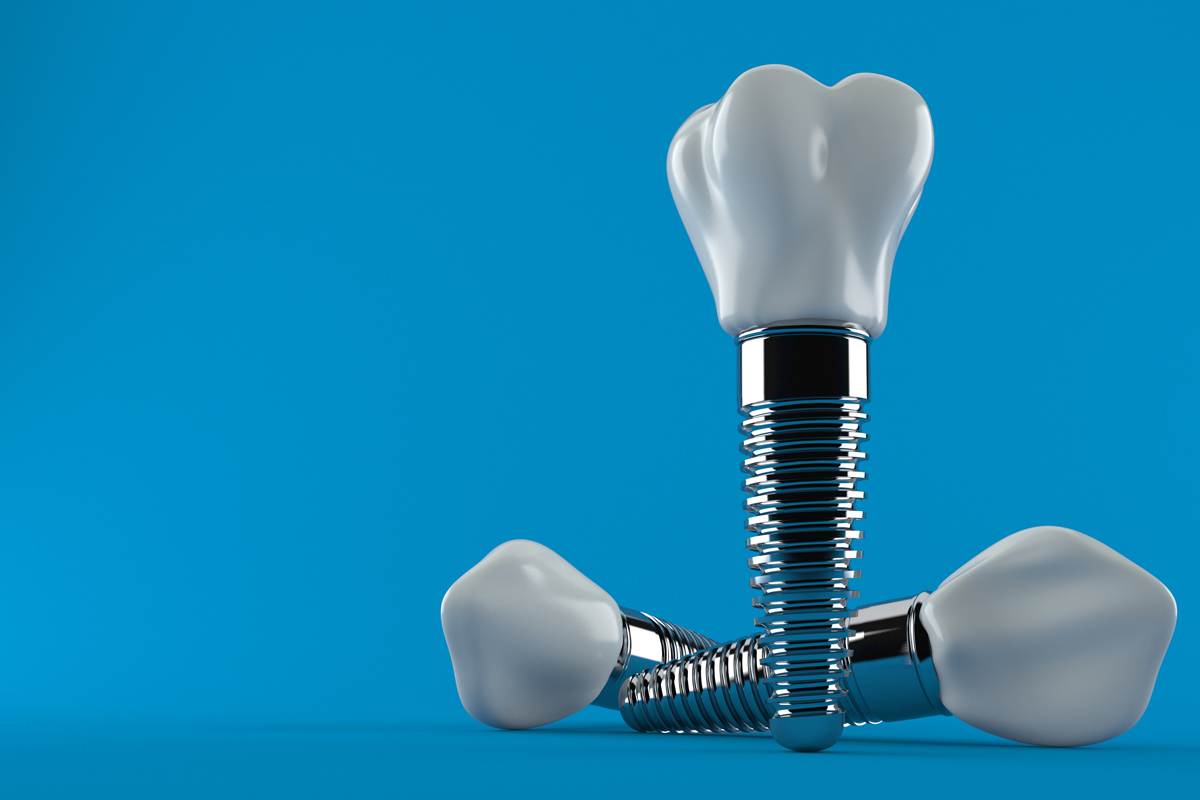 What Are They Saying About Dental Implants?
