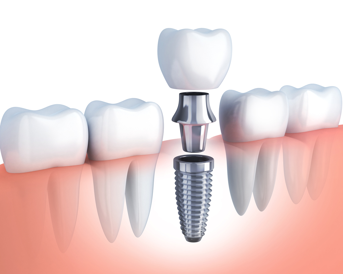 Preparing For Dental Implants